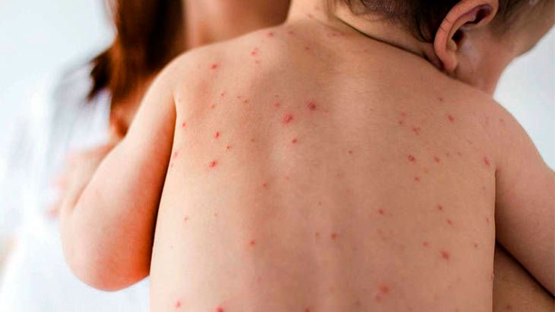 Piden que niños y adultos completen esquemas de vacunación contra sarampión
