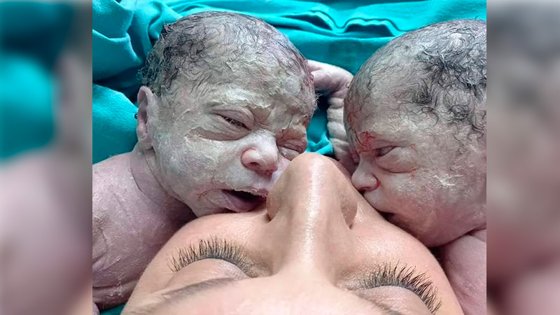 Nacieron gemelas y el embarazo fue “único y extraño” por dos características
